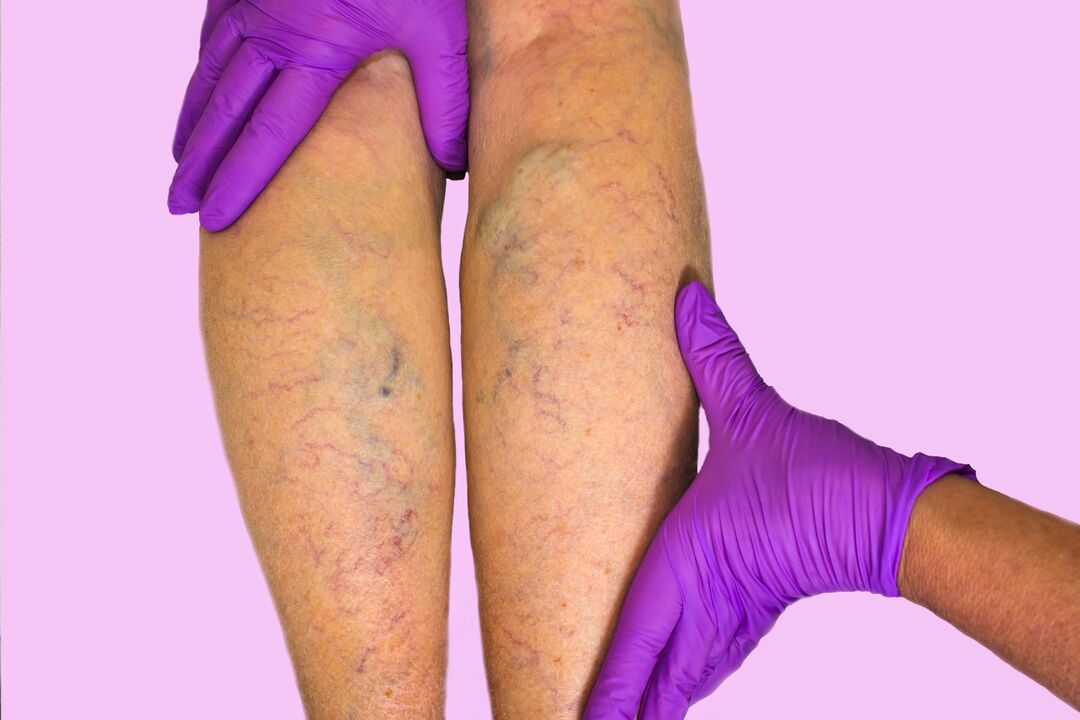 Varicose veins on the legs