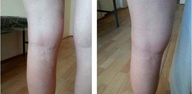 Varicose veins on the legs